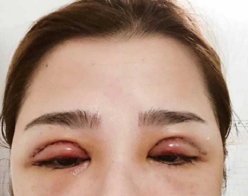 Kangnam may use cold Plasma treatment to support comfort and swelling management following eyelid surgery.