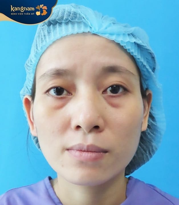Mắt bị sụp mí mức độ nhẹ