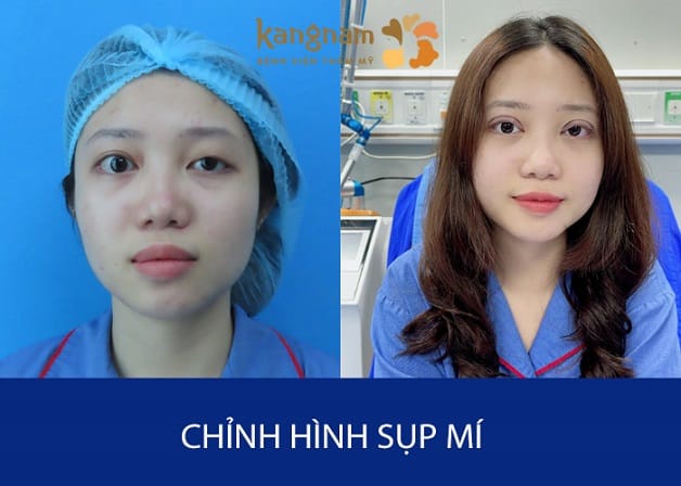 Chỉnh hình sụp mí bẩm sinh tại Kangnam