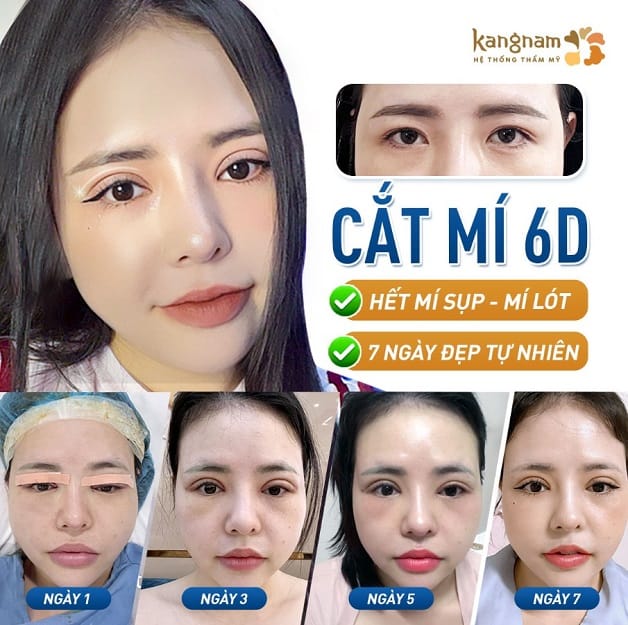 Cắt mí 6D khắc phục tình trạng sụp mí mắt hiệu quả