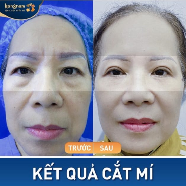 Nếp mí đều đẹp, không còn tình trạng sụp mí