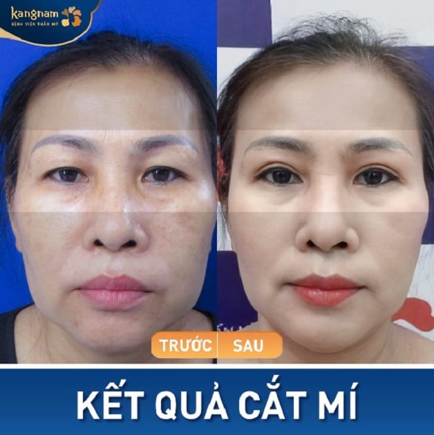Khắc phục tình trạng mí mắt sụp che lấp đồng tử