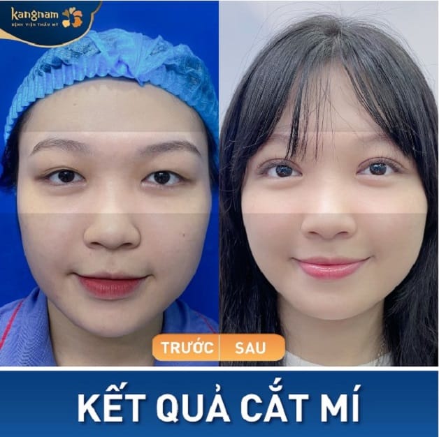 Đôi mắt lờ đờ được loại bỏ, trở nên có hồn hơn