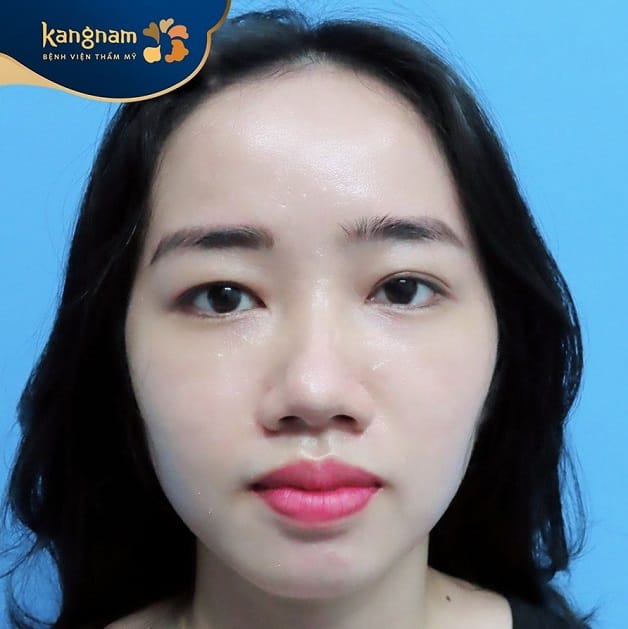 Sụp mí do rối loạn cơ nâng mi