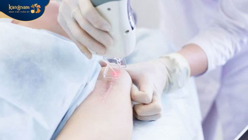 Tia laser có công dụng cắt đứt mạch máu nuôi dưỡng vùng da sẹo lồi