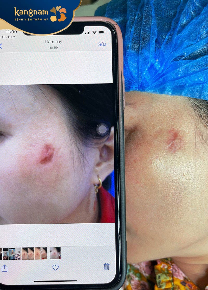 Điều trị sẹo lồi lâu năm đúng cách sẽ giúp làm mờ vết sẹo hiệu quả