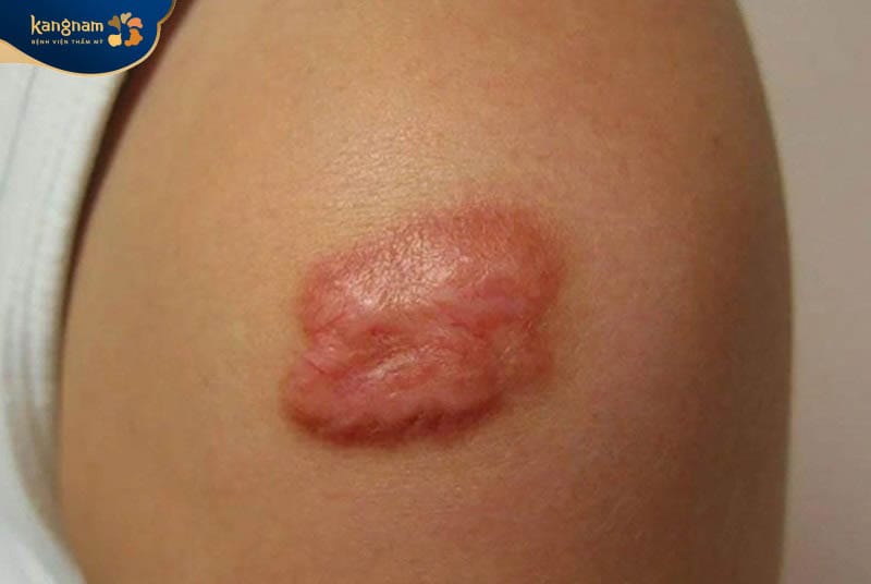 Những vết sẹo lồi vẫn có khả năng tái phát