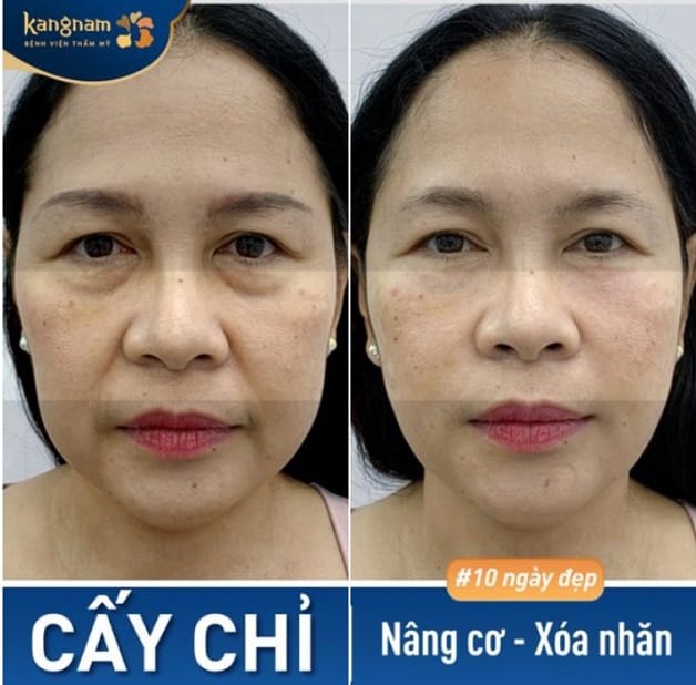 Vùng da nhăn, trùng nhão được cải thiện lên đến 90%