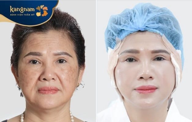 Trẻ hóa ra 10 tuổi sau căng chỉ collagen