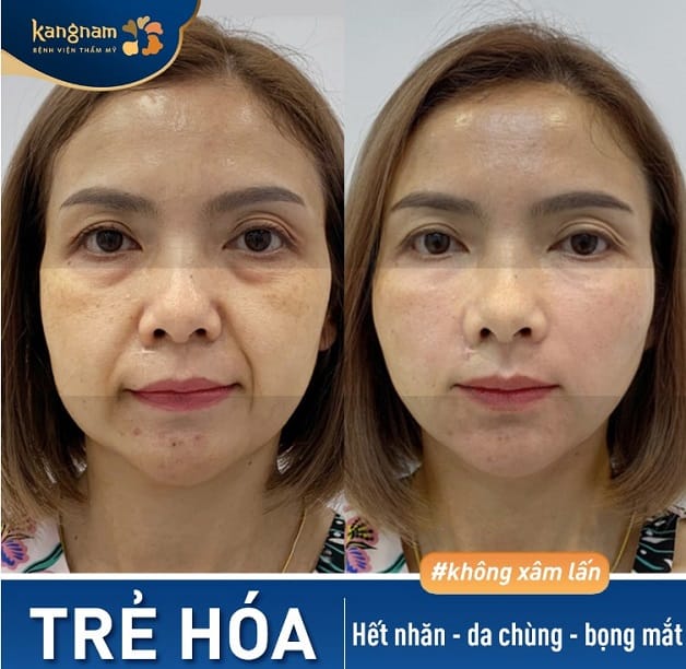 Bọng mắt, rãnh cười được loại bỏ sau căng chỉ