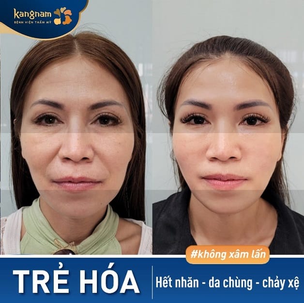 Gương mặt cân đối, đường nét hài hòa, trẻ trung sau căng chỉ collagen