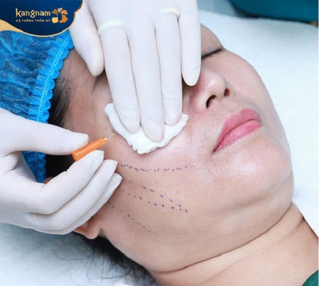 Collagen Thread Lift: Youthful Skin Without Surgery