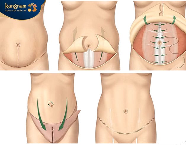 The surgical muscle-tightening process used in a standard tummy tuck.