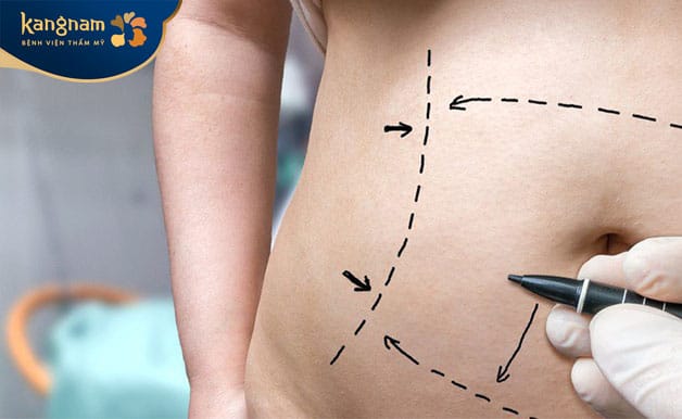 Panniculectomy removes excess, wrinkled skin from the lower abdomen, helping create a smoother abdominal contour.