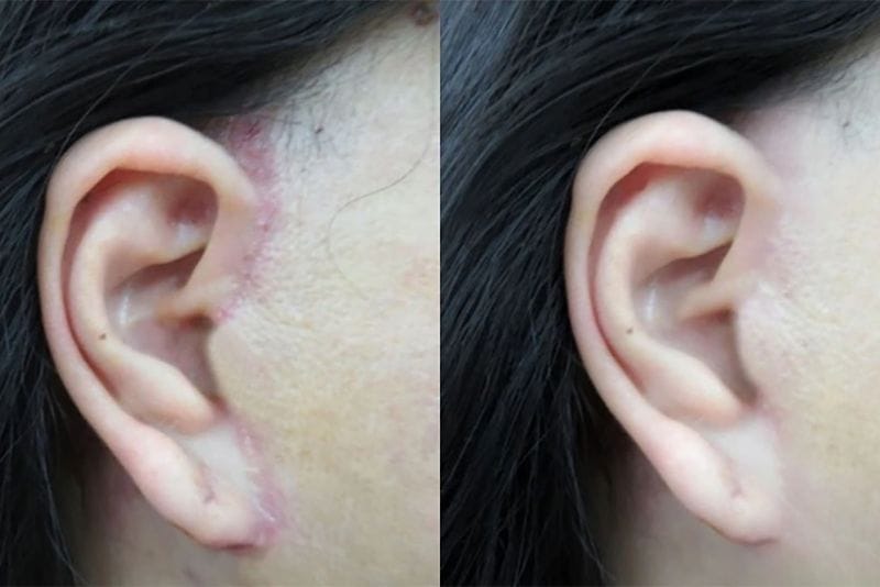 Certain foods should be limited after a facelift to support healing and reduce the risk of unfavourable scarring.