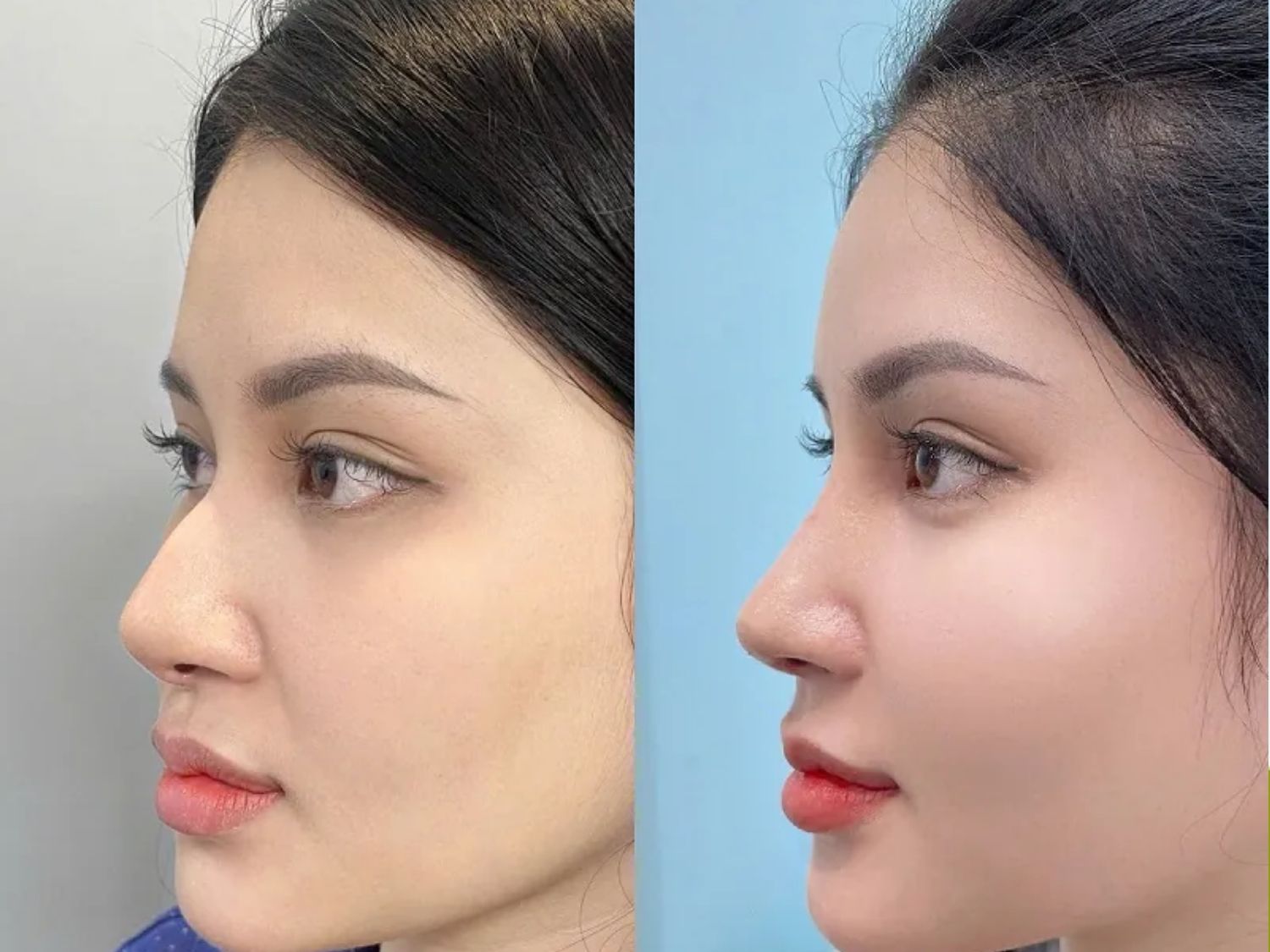The nose recovers quickly after surgery, helping patients save time.