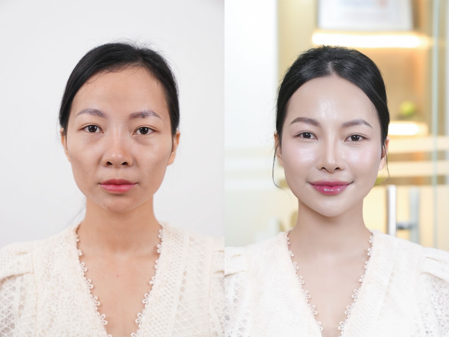 Filler results generally last approximately 6–24 months.
