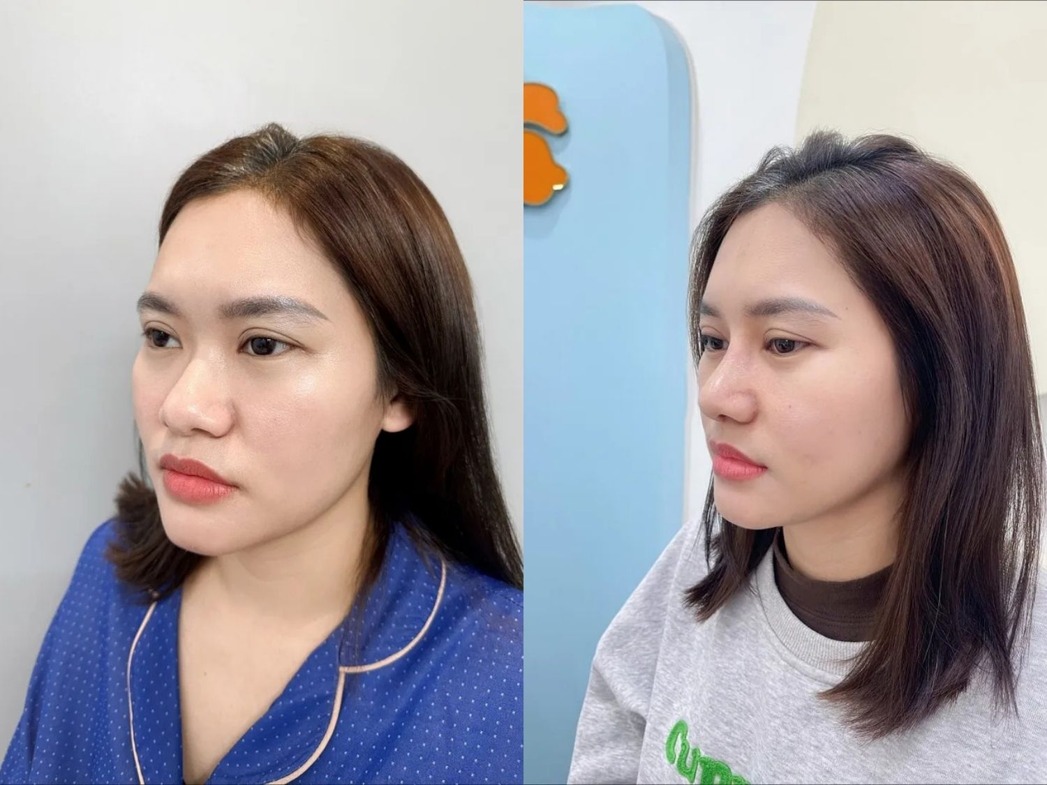 Ear cartilage rhinoplasty is considered safe when performed appropriately and is not expected to negatively affect overall health.