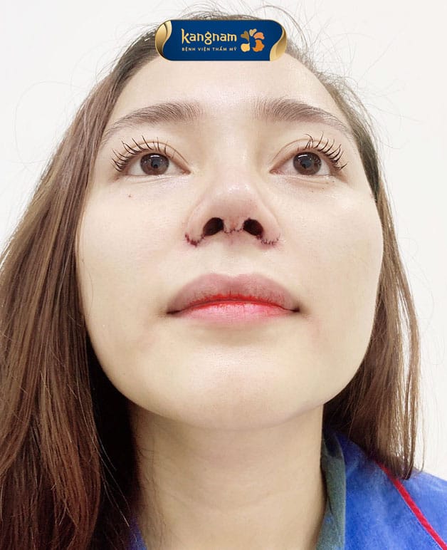 Khách hàng thực hiện thu nhỏ cánh mũi tại Kangnam