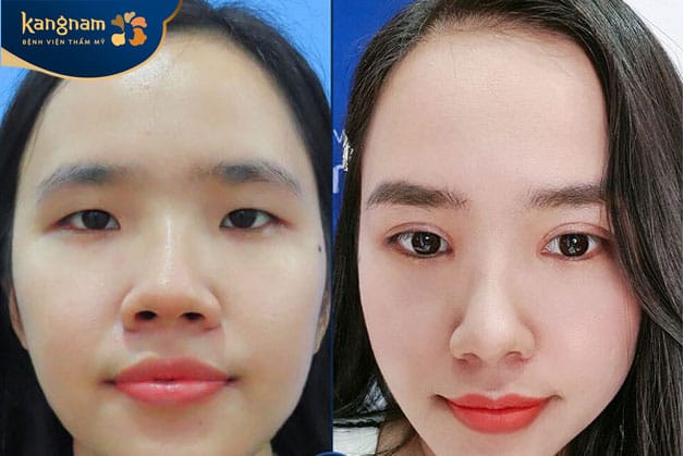Thu nhỏ cánh mũi giúp gương mặt thanh thoát hơn