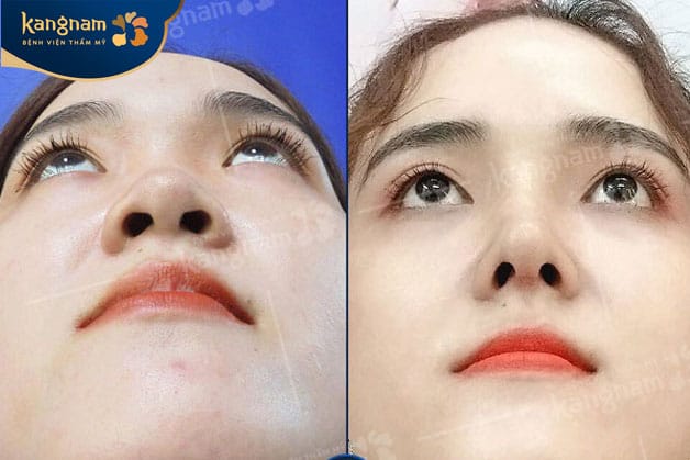 Cánh mũi nhỏ, tạo hiệu ứng chóp mũi sắc nét