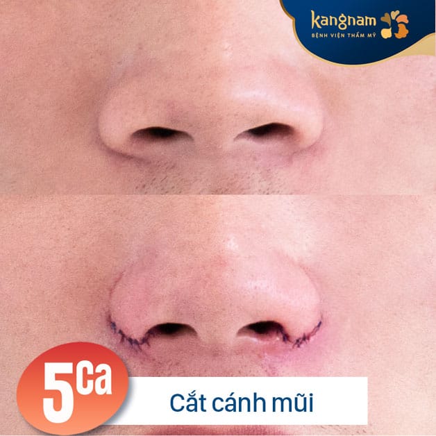 Cắt cánh mũi tại Kangnam giúp mũi cân đối, gọn và đẹp hơn