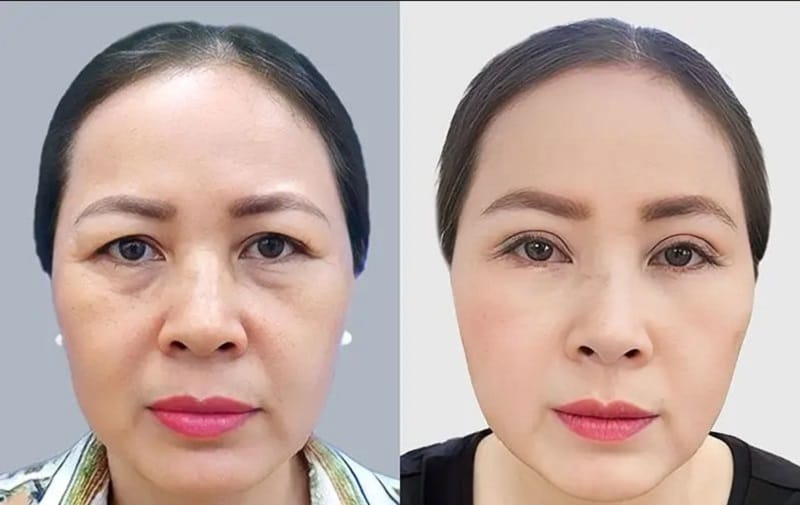 Lower eyelid surgery may improve excess skin and under-eye fullness in suitable patients.