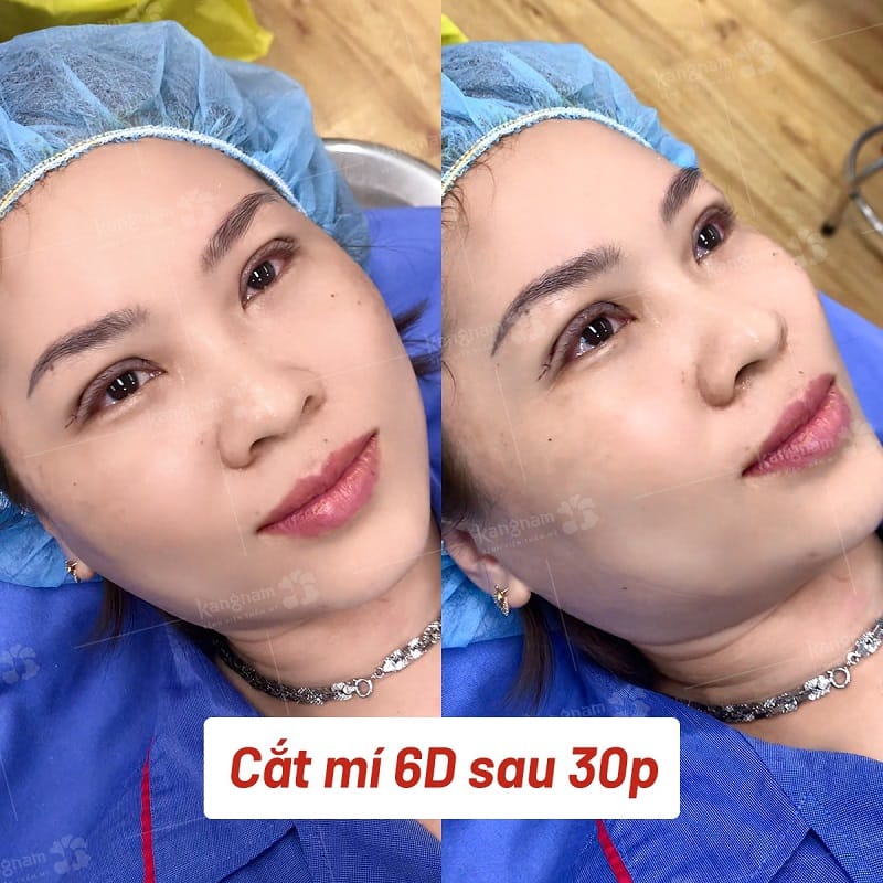 BÁC SĨ ĐANG THỰC HIỆN PHẪU THUẬT CẮT MÍ MẮT TRONG PHÒNG MỔ VÔ TRÙNG
