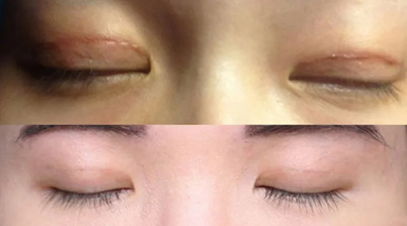There are many causes for the recurrence of eyelid issues. 