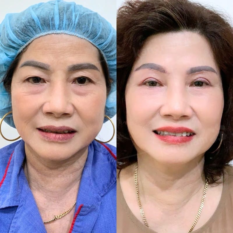 The eyelid crease may gradually change as the surrounding tissues continue to age.