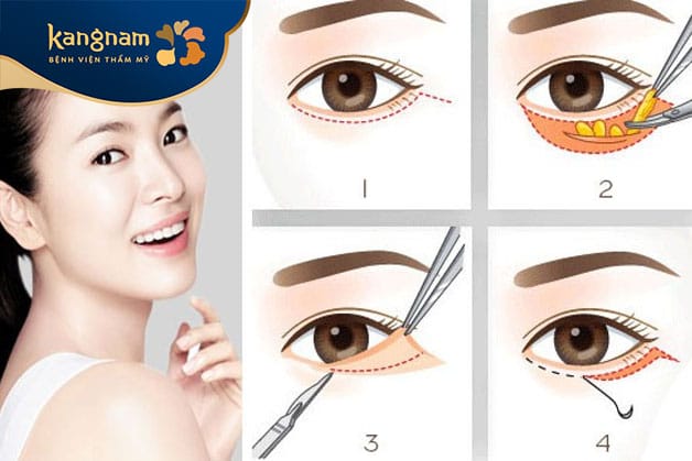 CẮT MÍ MẮT LÀ GÌ VÀ VÌ SAO ĐƯỢC ƯA CHUỘNG HIỆN NAY