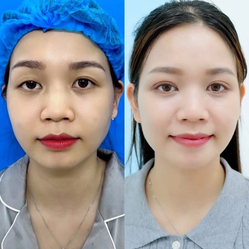 An eyelid crease may remain well defined for many years after appropriate surgery.
