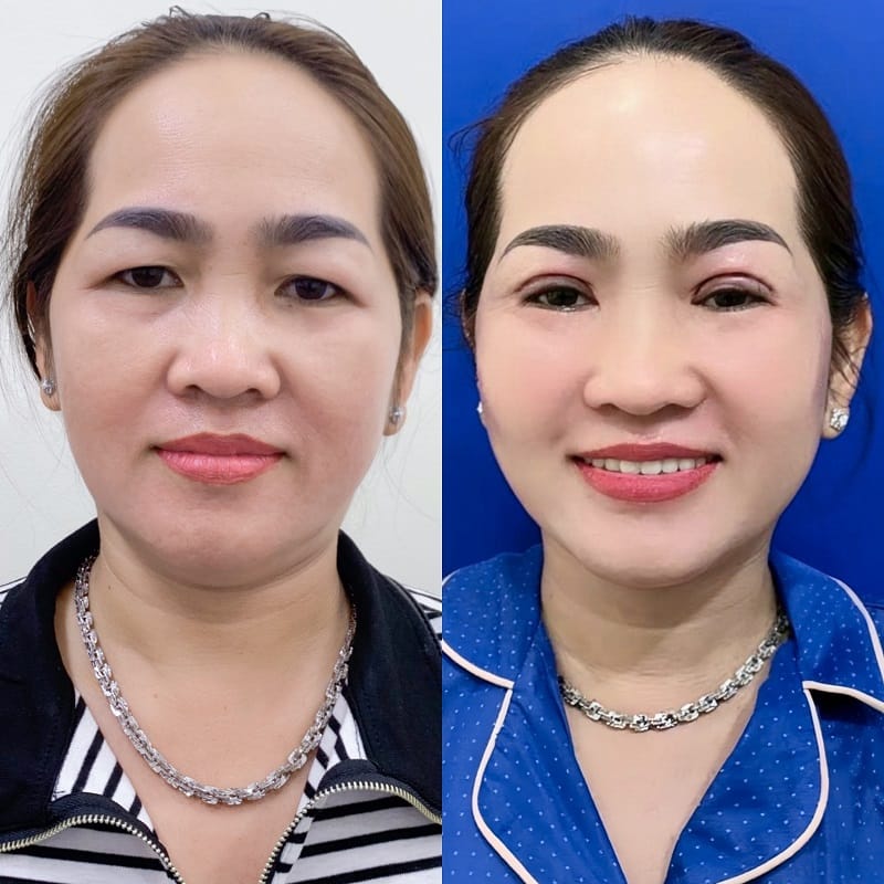 Age-related skin laxity may gradually affect the appearance of a previously created eyelid crease.