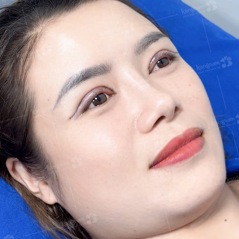Water should not be allowed to soak or strongly strike a fresh eyelid incision.