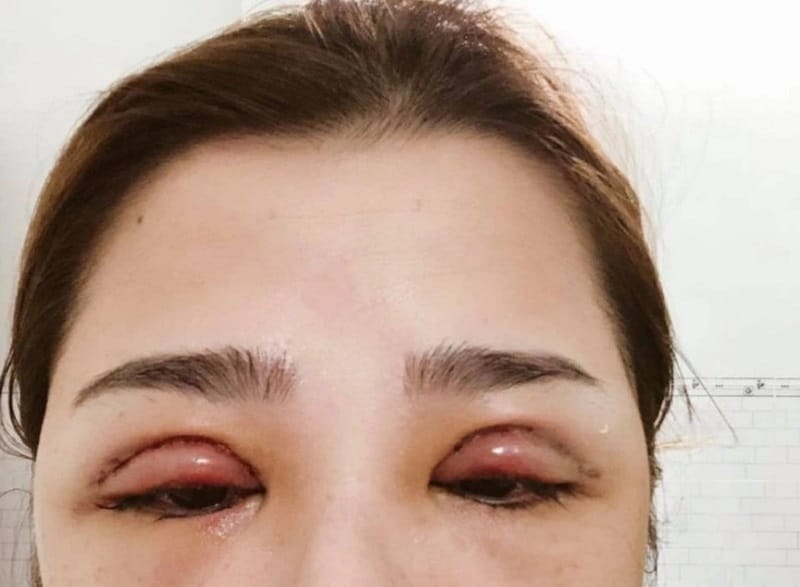 An infected eyelid incision may remain swollen and require medical treatment.