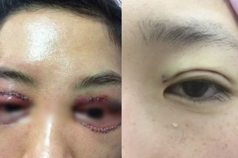 Poor wound healing may cause prolonged swelling or a noticeable eyelid scar.