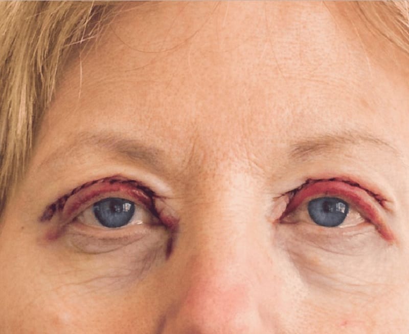 Patients with active eye disease should receive appropriate medical assessment before elective eyelid surgery.