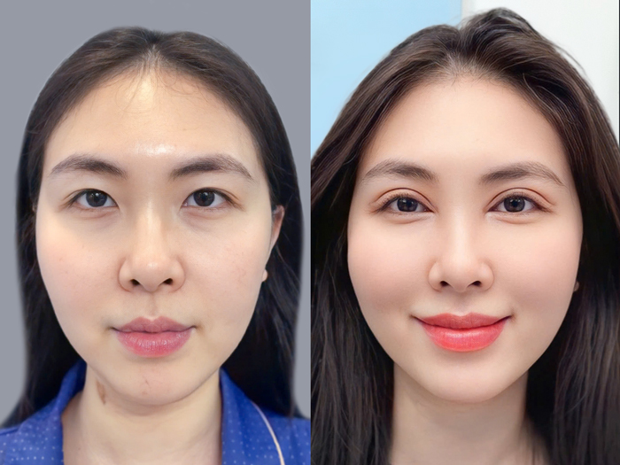 The eyelids may appear more balanced as swelling decreases and the incision heals.