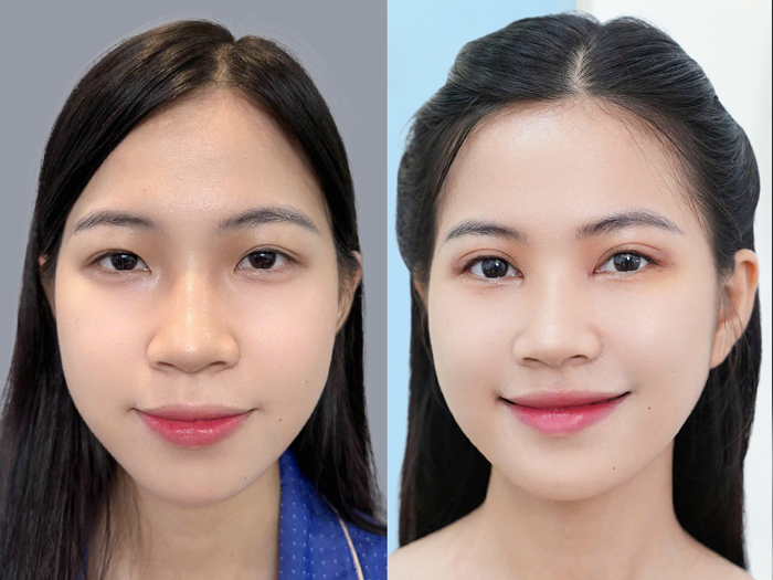 Makeup may be resumed once the eyelids have healed and the crease has begun to stabilise.