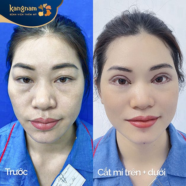 NỮ BÁC SĨ ĐANG TƯ VẤN CHO KHÁCH HÀNG VỀ DỊCH VỤ CẮT MÍ MẮT TẠI PHÒNG KHÁM