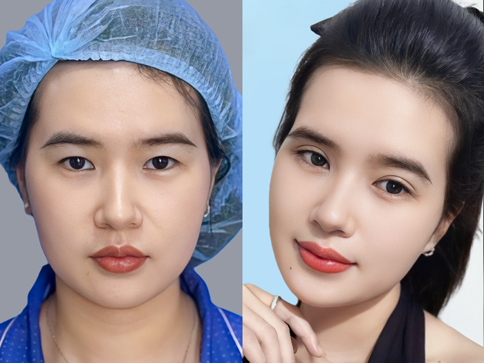 Blepharoplasty may improve loose eyelid skin but does not reposition a protruding eyeball.
