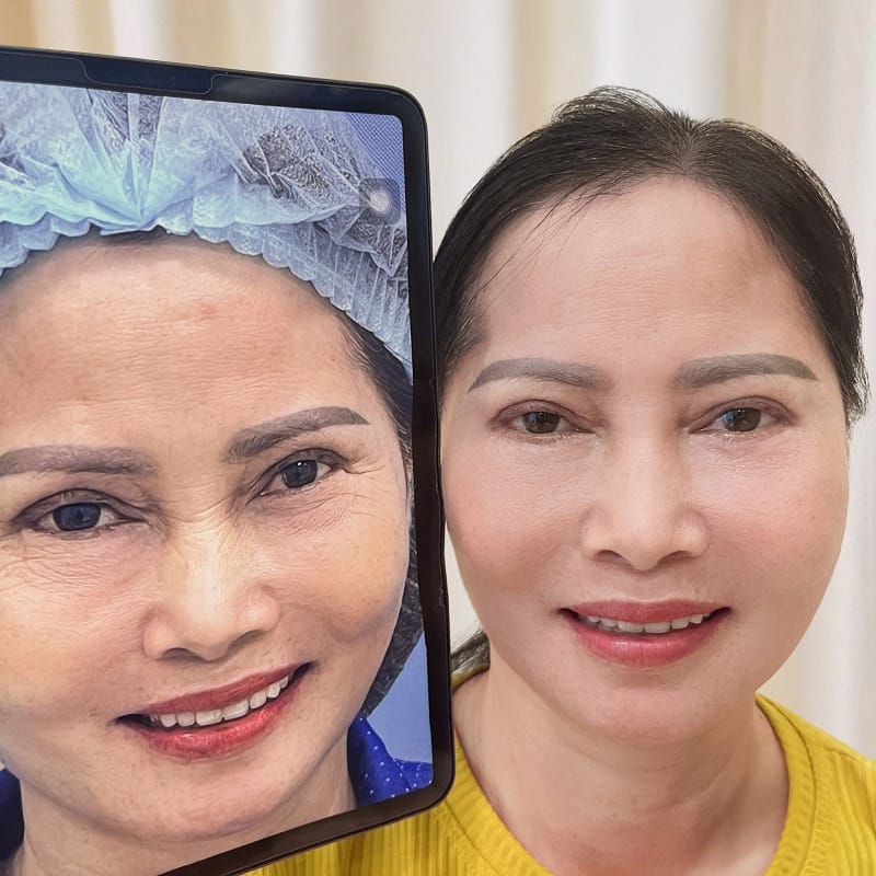 The result may appear increasingly natural as swelling subsides and the transferred fat stabilises.