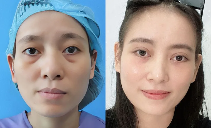 Fat grafting to the eye socket will stabilize after a period of time.