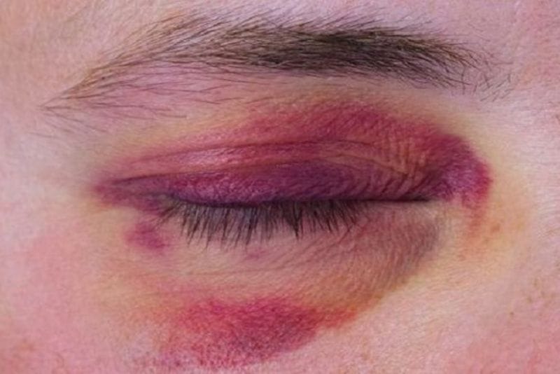 Poorly performed low-cost eye fat grafting may result in visible irregularities or other complications.