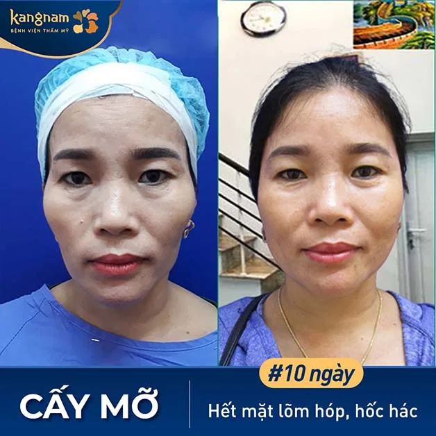 Autologous fat grafting will automatically reject 30–50% of the fat