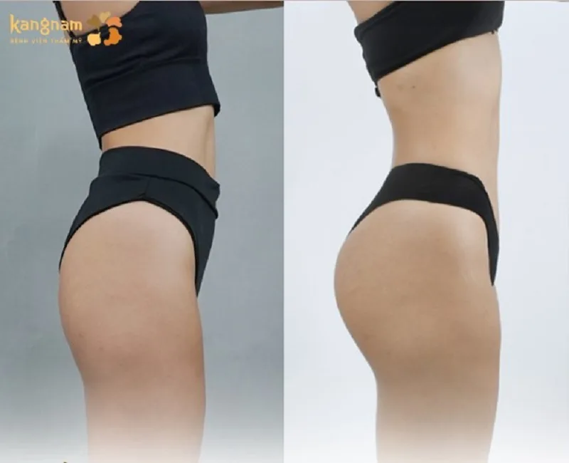 Long-lasting results with soft, natural-feeling buttock fat
