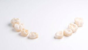 Cercon Zirconia Porcelain Crowns: Benefits & Durability