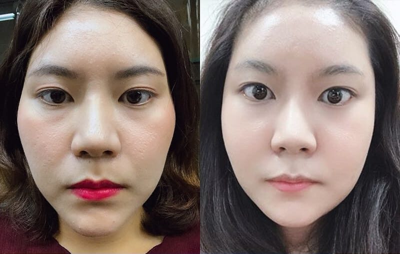Clients with high, complex cheekbones will require a combination of surgical techniques