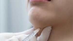 How Much Does a Chin Fat-Dissolving Injection Cost?