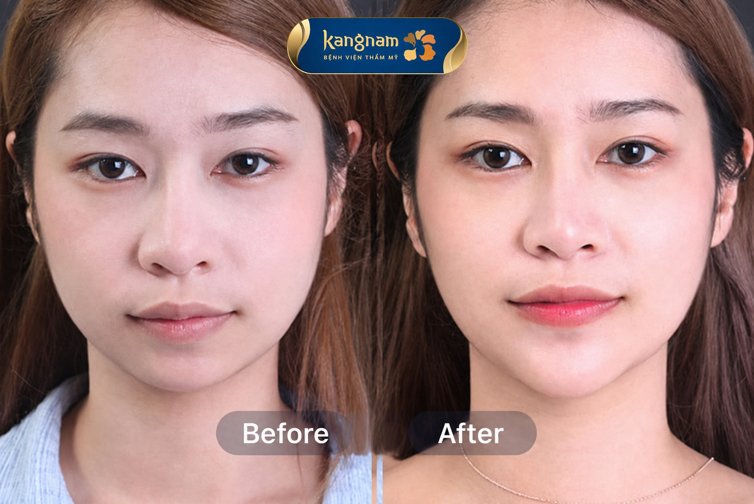 The chin appears more projected and proportionate following treatment.